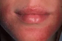 симптоми