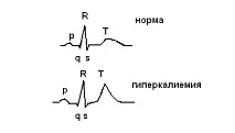 хиперкалиемична