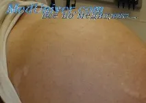 Перкусія рідини у животі животі