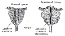 простатиті