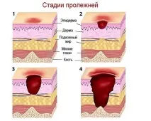 пролежнів