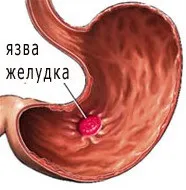 Симптоми виразки шлунка, якрозпізнати хворобу на ранніх етапах симптоми