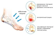 Симптоми шпори п’яти. симптоми