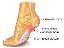 Симптоми шпори п’яти. симптоми