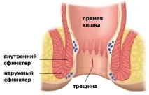 Анальна тріщина причини, методи лікування, видалення та фото анальна