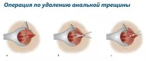 Анальна тріщина причини, методи лікування, видалення та фото тріщина