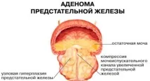 цистостома