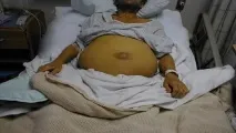 Цироз печінки на останній стадії фото людей цироз
