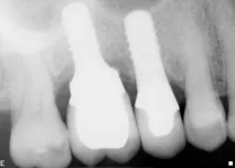 Dental-Revue, Статті, Ортопедична, Індивідуальні абатменти не запобіжать клінічним ефектам статті