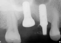 Dental-Revue, Статті, Ортопедична, Індивідуальні абатменти не запобіжать клінічним ефектам ортопедична