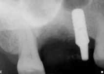 Dental-Revue, Статті, Ортопедична, Індивідуальні абатменти не запобіжать клінічним ефектам ортопедична