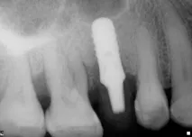 Dental-Revue, Статті, Ортопедична, Індивідуальні абатменти не запобіжать клінічним ефектам ортопедична