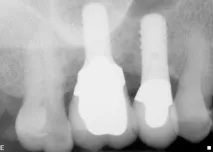 Dental-Revue, Статті, Ортопедична, Індивідуальні абатменти не запобіжать клінічним ефектам ортопедична