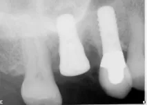 Dental-Revue, Статті, Ортопедична, Індивідуальні абатменти не запобіжать клінічним ефектам статті