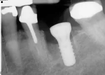 Dental-Revue, Статті, Ортопедична, Індивідуальні абатменти не запобіжать клінічним ефектам ортопедична
