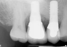 Dental-Revue, Статті, Ортопедична, Індивідуальні абатменти не запобіжать клінічним ефектам dental-revue