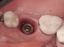 Dental-Revue, Статті, Ортопедична, Індивідуальні абатменти не запобіжать клінічним ефектам dental-revue