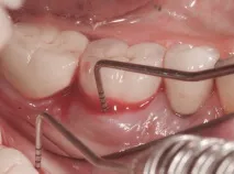 Dental-Revue, Статті, Ортопедична, Індивідуальні абатменти не запобіжать клінічним ефектам dental-revue