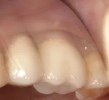 Dental-Revue, Статті, Ортопедична, Індивідуальні абатменти не запобіжать клінічним ефектам статті