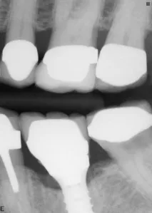 Dental-Revue, Статті, Ортопедична, Індивідуальні абатменти не запобіжать клінічним ефектам статті