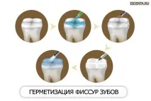 Герметизація фісур показання та етапи проведення процедури, Стоматологічна клініка Дента показання