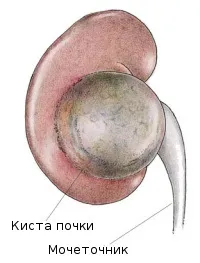 Як діагностують кісту нирки у новонароджених діагностують