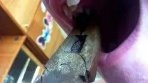 Як самому вирвати корінний зуб без ускладнень корінний