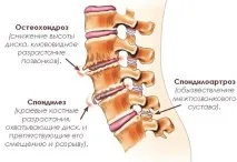 спондилоза