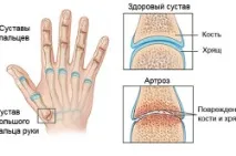 Лікування артрозу пальців рук хвороби