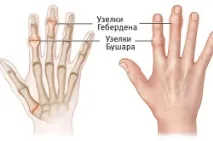 Лікування артрозу пальців рук лікування