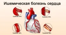 ЛФК при ІХС або гімнастика при ішемічній хворобі серця вправ