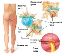 Люмбалгія симптоми та лікування симптоми