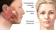 Парез лицевого нерва у яких випадках виникає і як лікувати лицевого