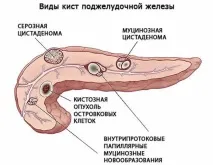 панкреаса