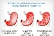 Поверхневий гастрит Лікування, дієта, симптоми поверхневий
