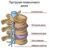 Протрузія міжхребцевого диска диска