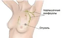 Рак грудей та метастази симптоми та перші ознаки метастази