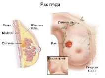 Рак грудей та метастази симптоми та перші ознаки метастази