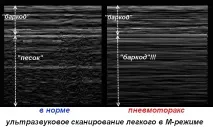 Регіонарна анестезія під контролем УЗД анестезія