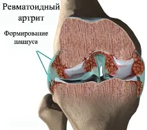 Ревматоїдний паннус, як формується паннус