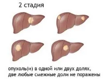 Скільки живуть із раком печінки – прогнози стадій раку живуть