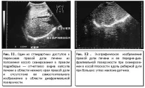 ультразвукова