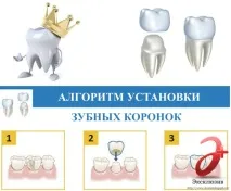 Установка зубних коронок в СПб - ціни, види, відгуки пацієнтів установка