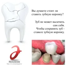 Установка зубних коронок в СПб - ціни, види, відгуки пацієнтів відгуки
