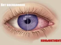 Алергічний кон’юнктивіт викликає не лише сльози сльози