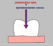 Адгезивні системи травлення