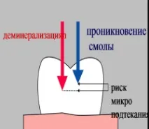 Адгезивні системи травлення