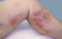 хірургічне
