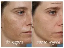 Хімічний пілінг шкіри обличчя та тіла шкіри