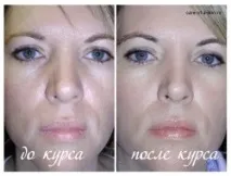 Хімічний пілінг шкіри обличчя та тіла обличчя